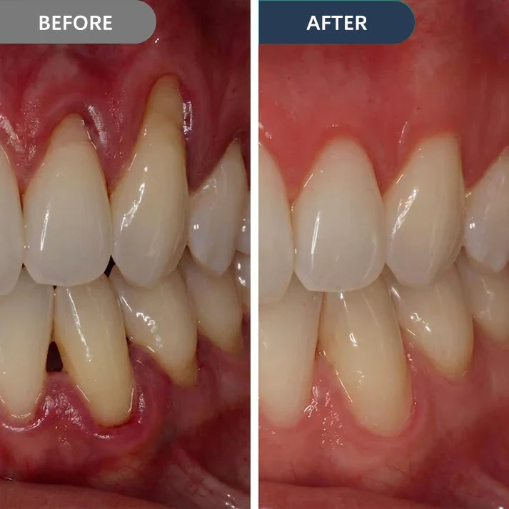 Bleeding When You Brush? Give Your Gums the Daily Support They’ve Been Missing.