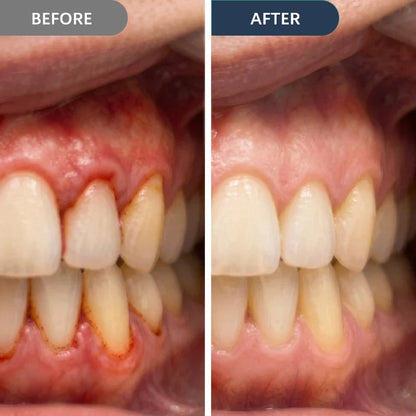 Bleeding When You Brush? Give Your Gums the Daily Support They’ve Been Missing.